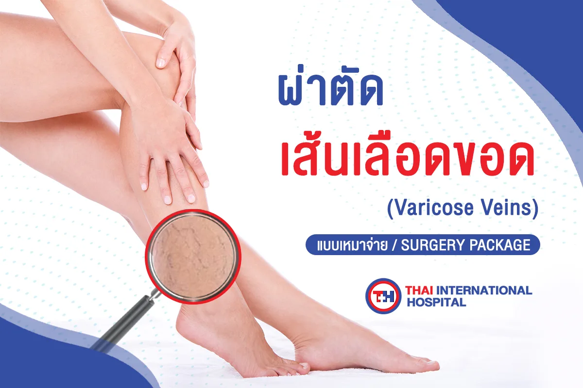 เส้นเลือดขอด-jpg.webp